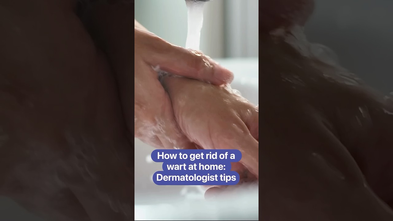 How to get rid of a wart at home: Dermatologist tips