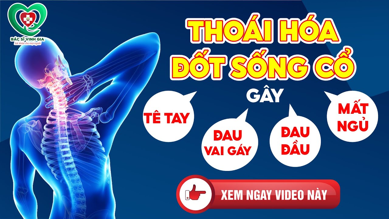 Thoái Hóa Đốt Sống Cổ gây Tê Tay, Đau Vai Gáy, Đau Đầu, Mất Ngủ - xem ngay video này