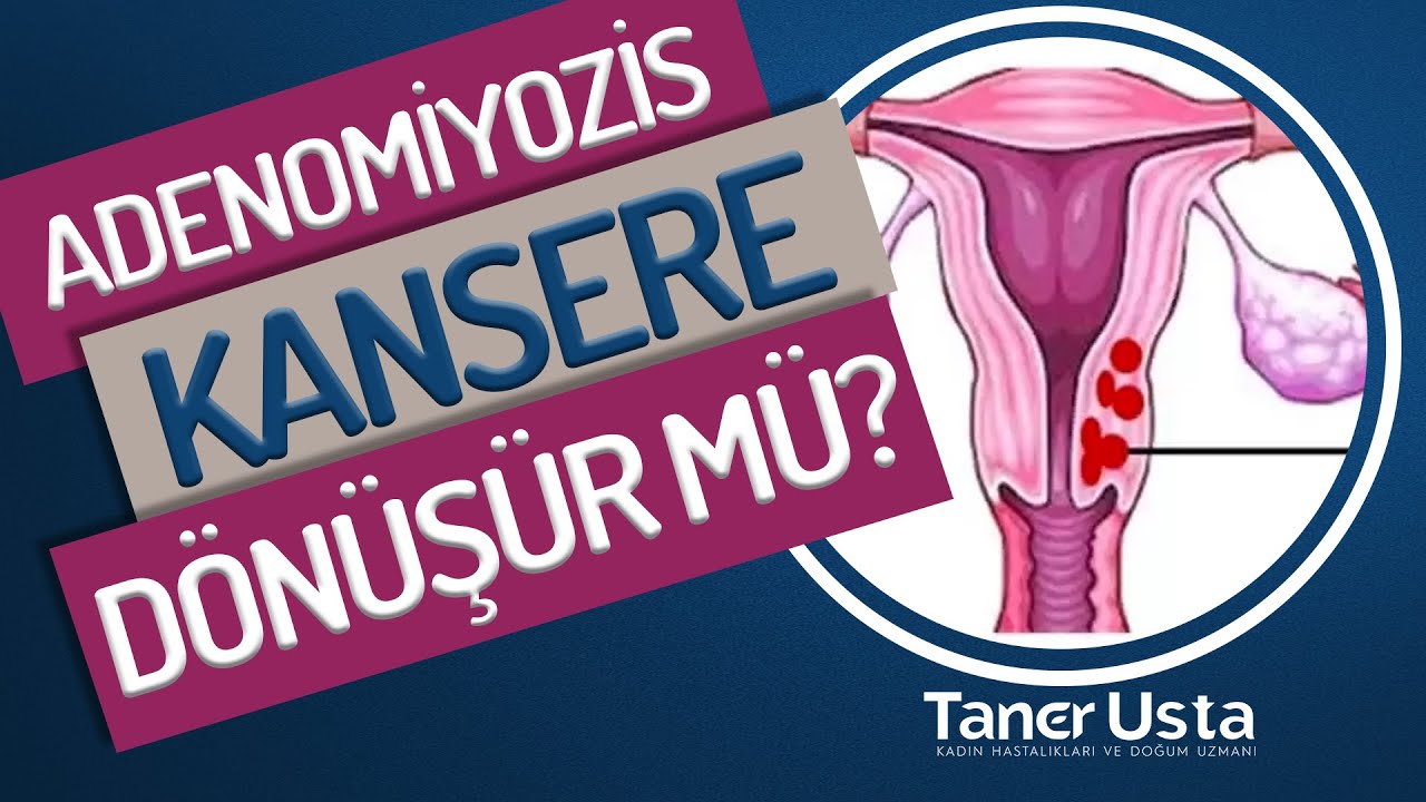 ADENOMYOZİS KANSERE D&Ouml;N&Uuml;Ş&Uuml;R M&Uuml;? - Prof. Dr. Taner Usta