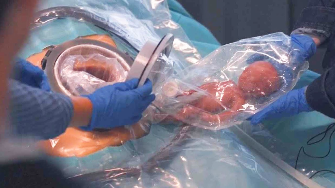 Doctors Create Artificial Womb To Help Premature Babies Grow Stronger