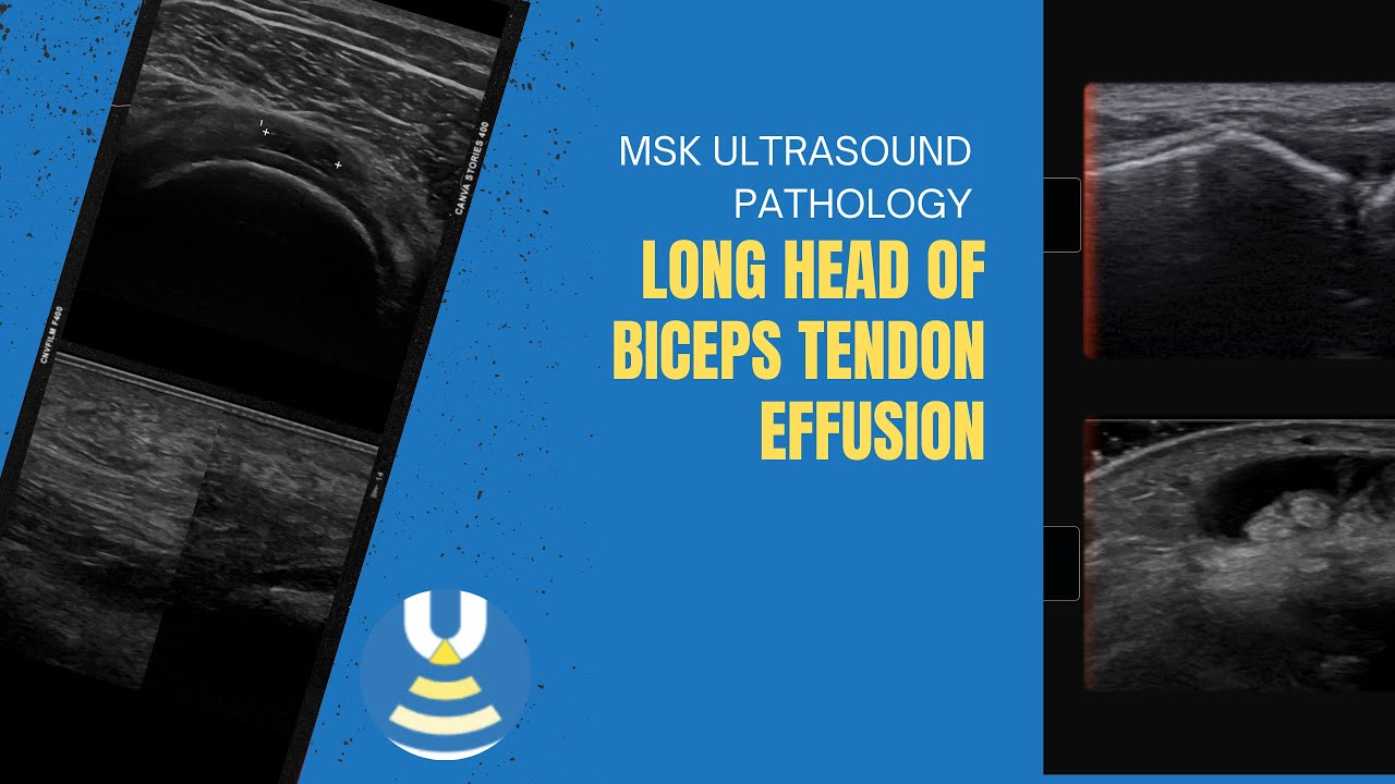 Long head of biceps tendon effusion on ultrasound