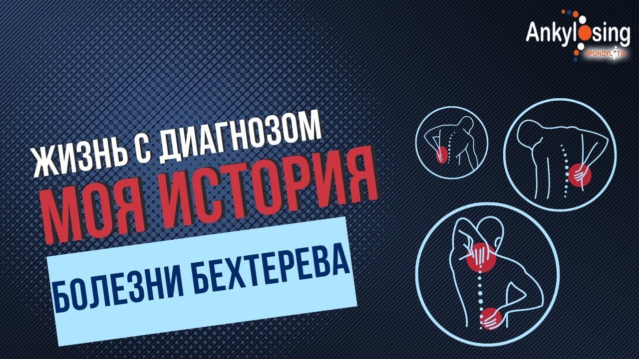 Жизнь с диагнозом болезнь Бехтерева|Моя история
