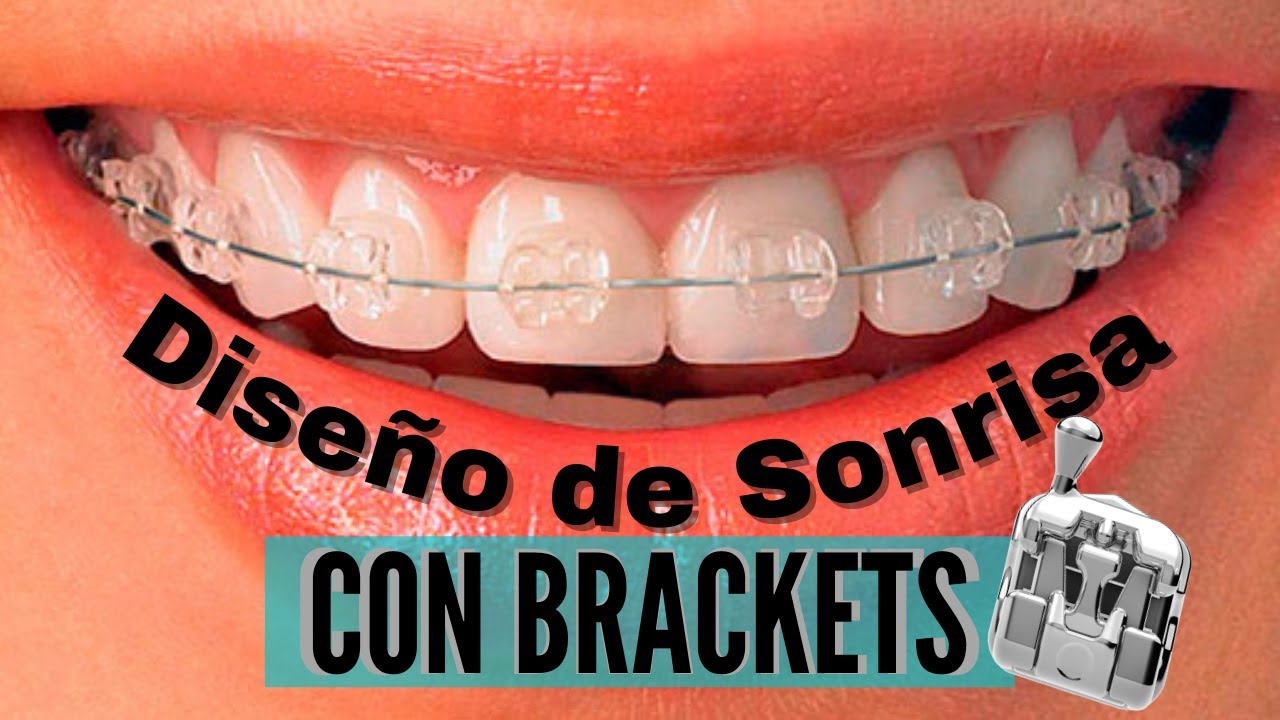 Diseño de SONRISA con BRACKETS, | ¡8 COMPONENTES QUE DEBE TENER UNA SONRISA PERFECTA! #2021