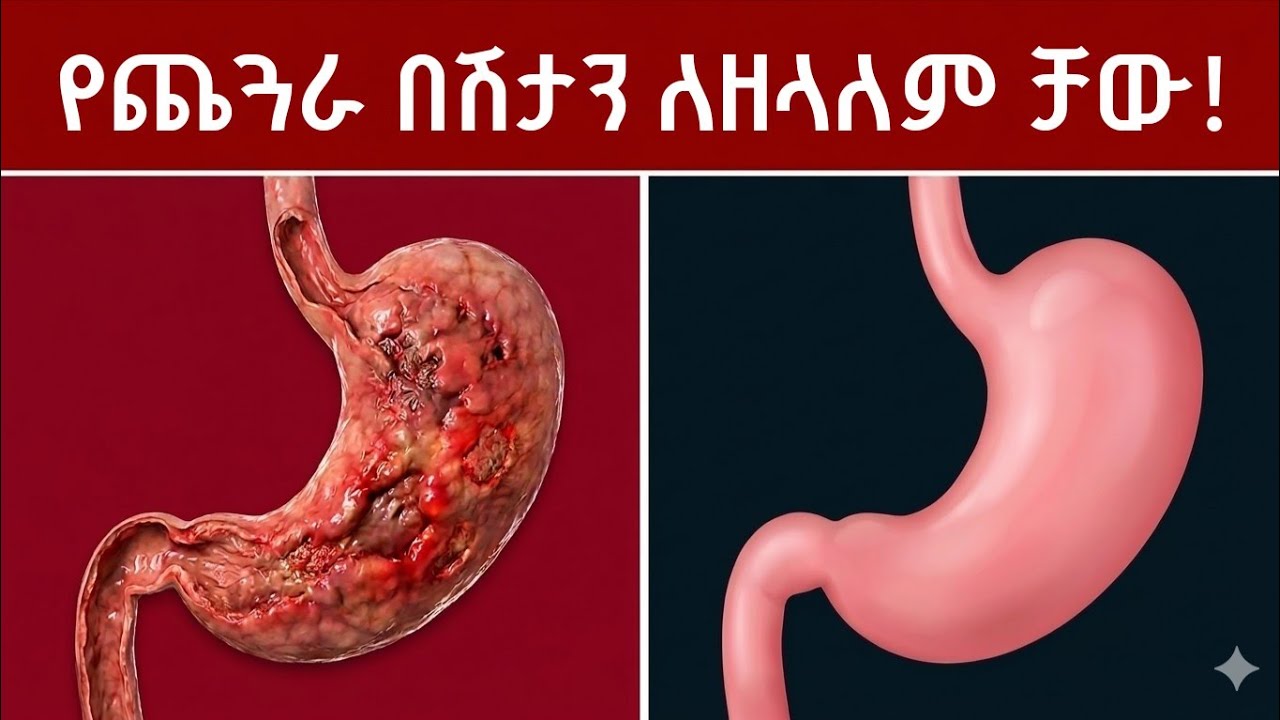 ይህን ሳያውቁ ጨጓራዬን አከምኩ እንዳይሉ! በሽታውን ከሥሩ የሚነቅሉ 10 ድንቅ መፍትሄዎች!