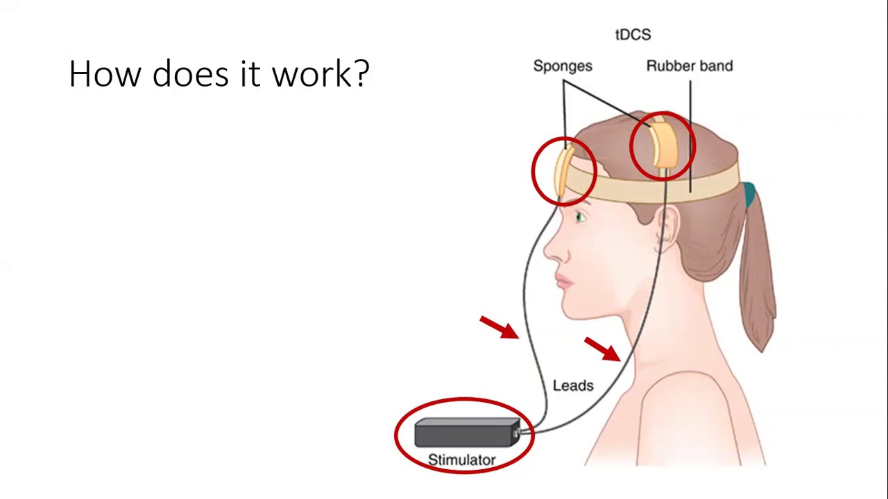Aphasia Answers: Is brain stimulation effective for aphasia treatment?