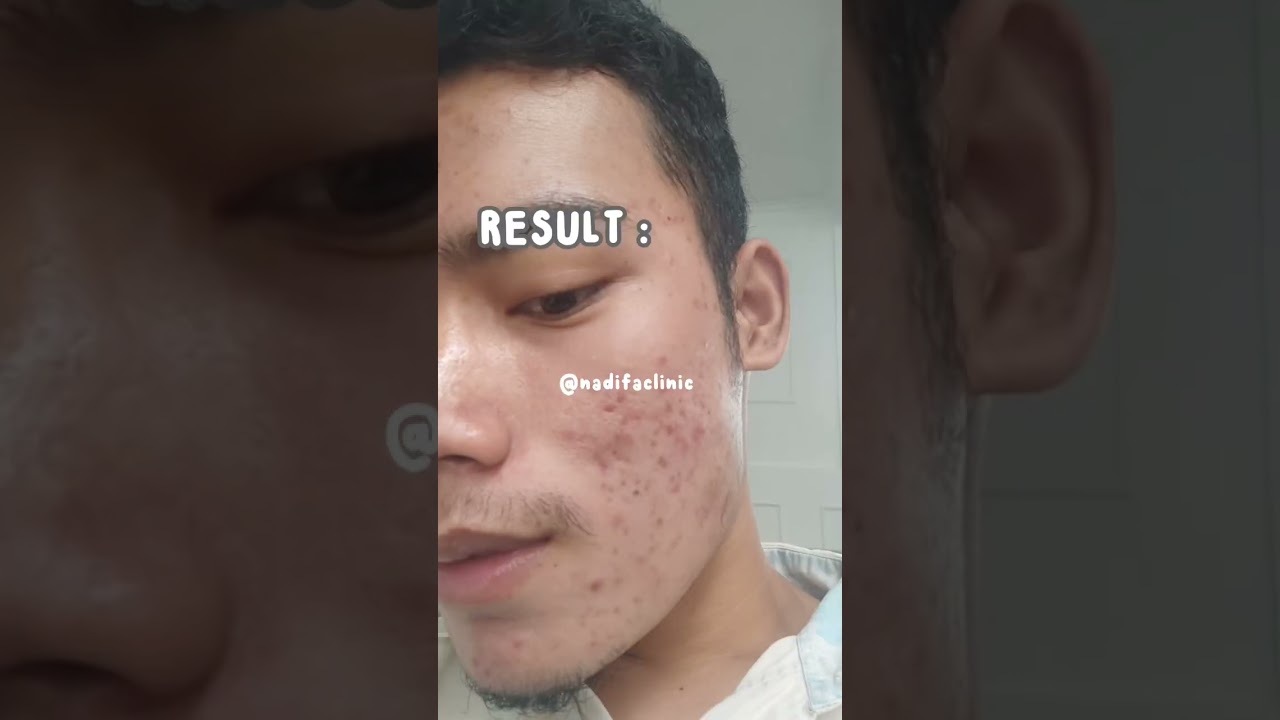 Udah gatau lagi deh mau bilang apalagi soal laser erbium. Sebagus itu😭 nadifaclinic #acnefighter