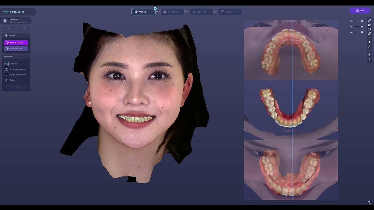 Digital Smile Design - Ortho Simulator | RAYFace workflow