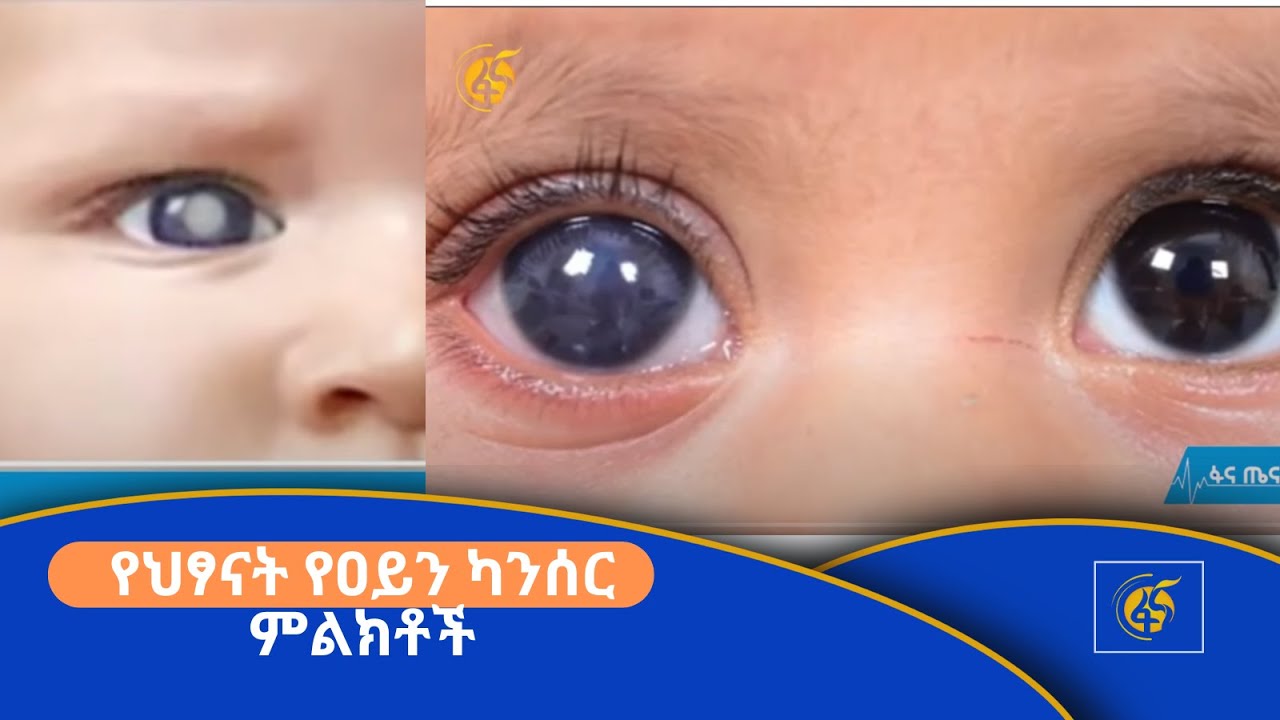 የህፃናት የዐይን ካንሰር ምልክቶች