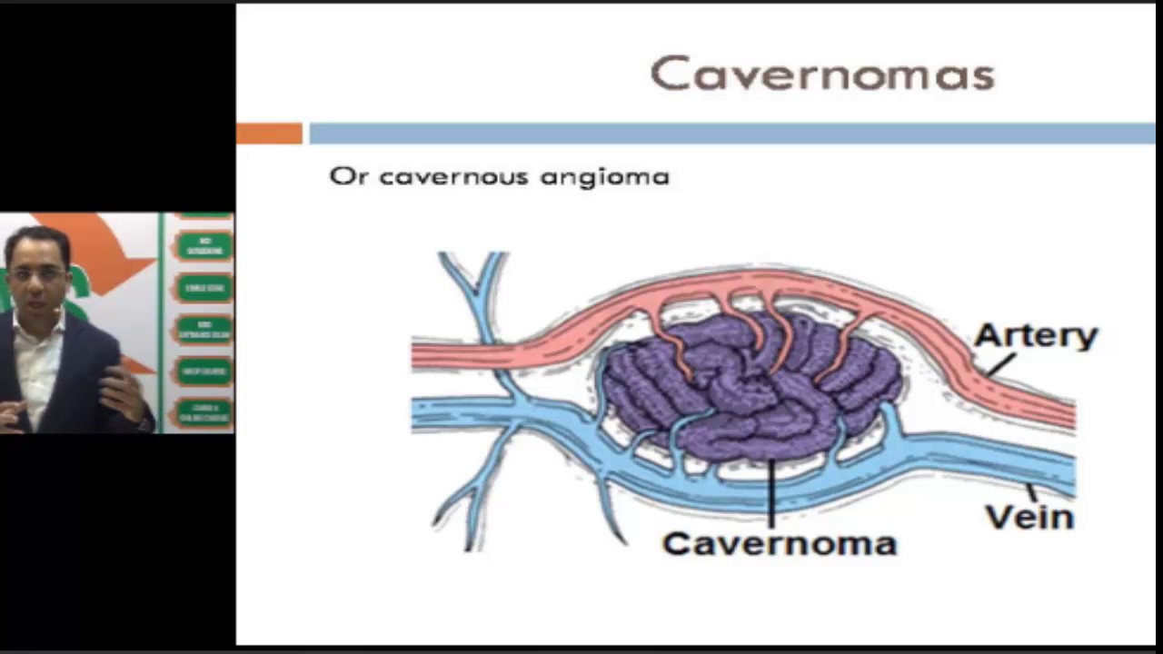 Non-neoplastic Vascular Malformations of the Brain #Radiology Spotter Series by Dr Sumer Sethi