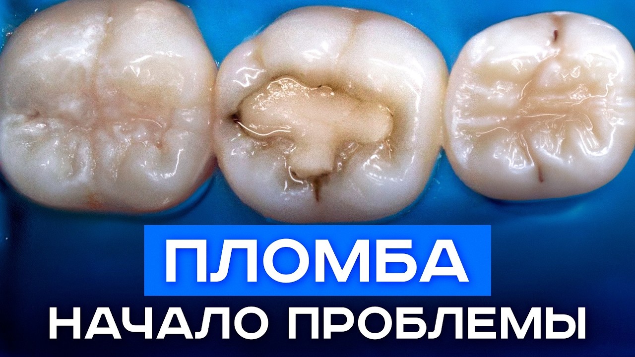 Самые главные ОШИБКИ лечения кариеса, о которых молчат стоматологи! / КАК правильно лечить зубы?