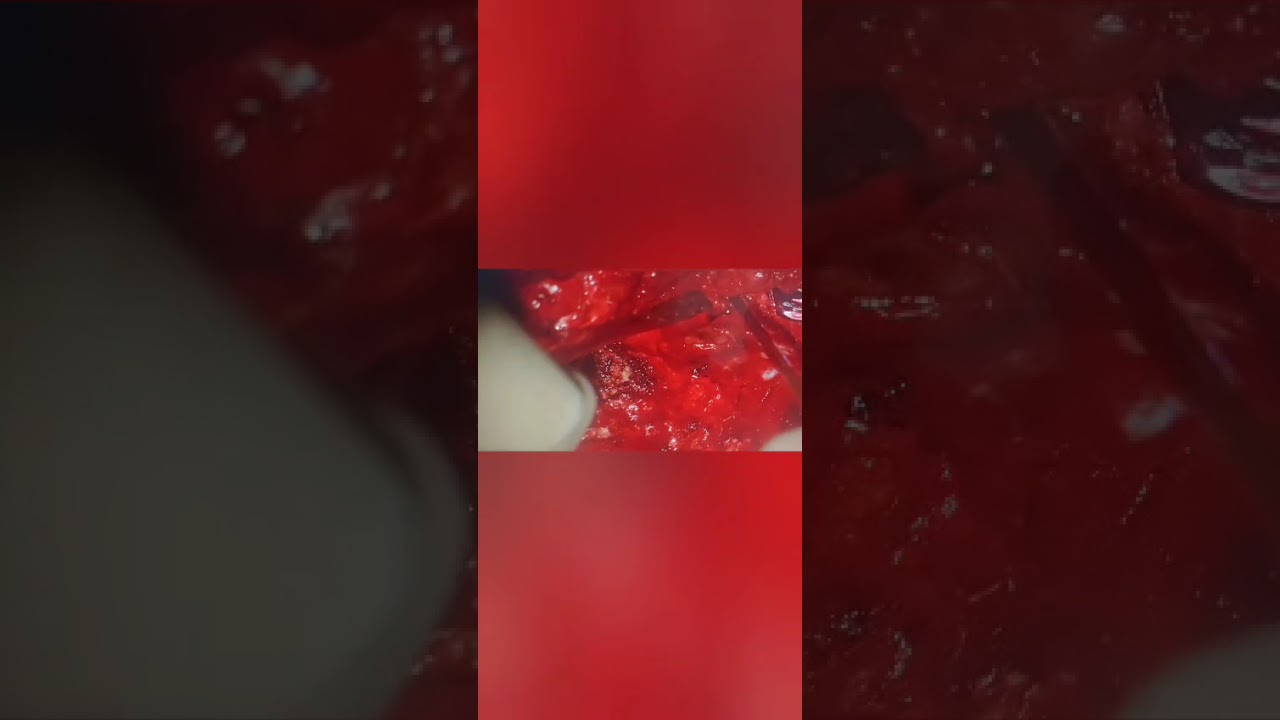 Difficult  TLIF with a sclerosed L5-S1 space