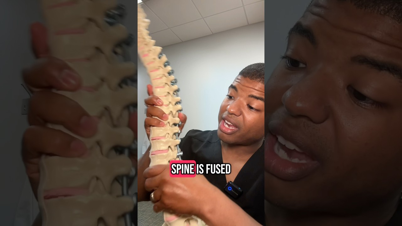 How much motion is expected after spine fusion?#scoliosis #scoliosistreatment