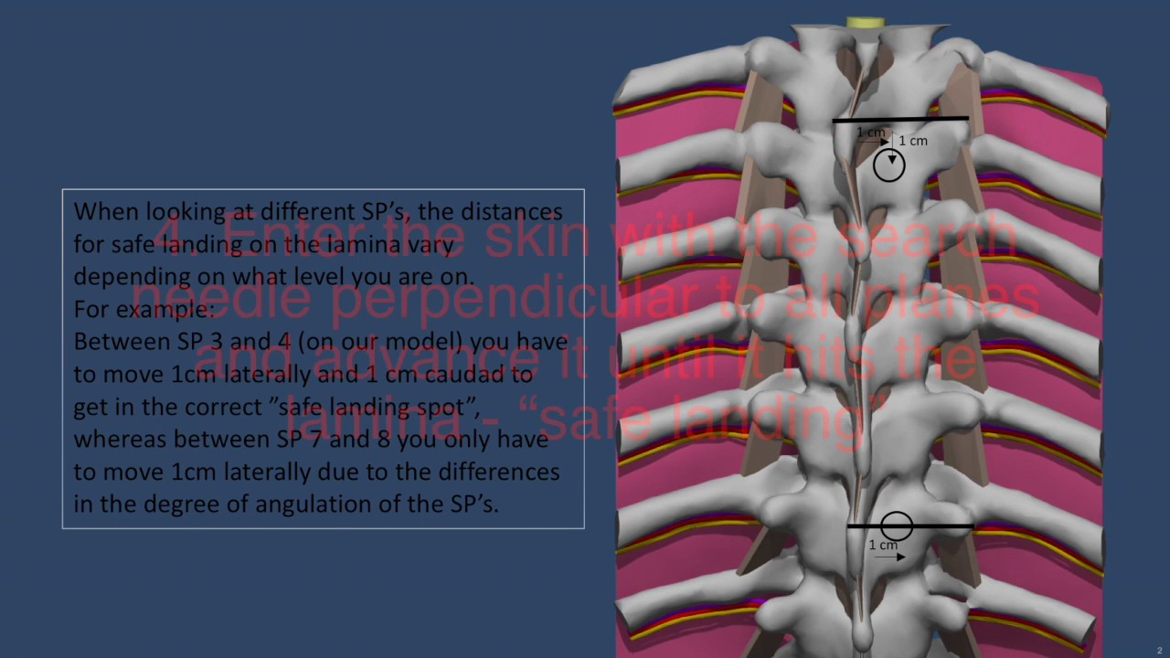 Landmark Based Thoracic Epidural