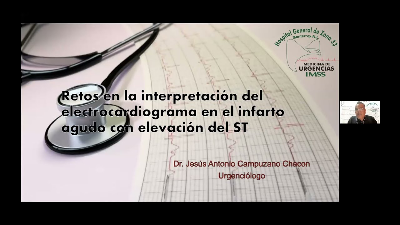 Retos en la interpretación del electrocardiograma en el infarto agudo con elevación del ST