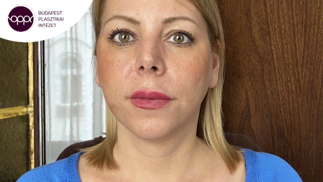 Andi arcplasztikai beavatkozása dr. Sobor Györgynél - EREDMÉNNYEL
