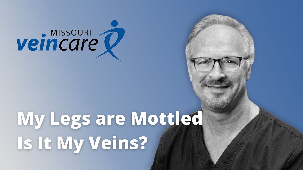 The Skin on My Legs is Mottled. Is It My Veins?
