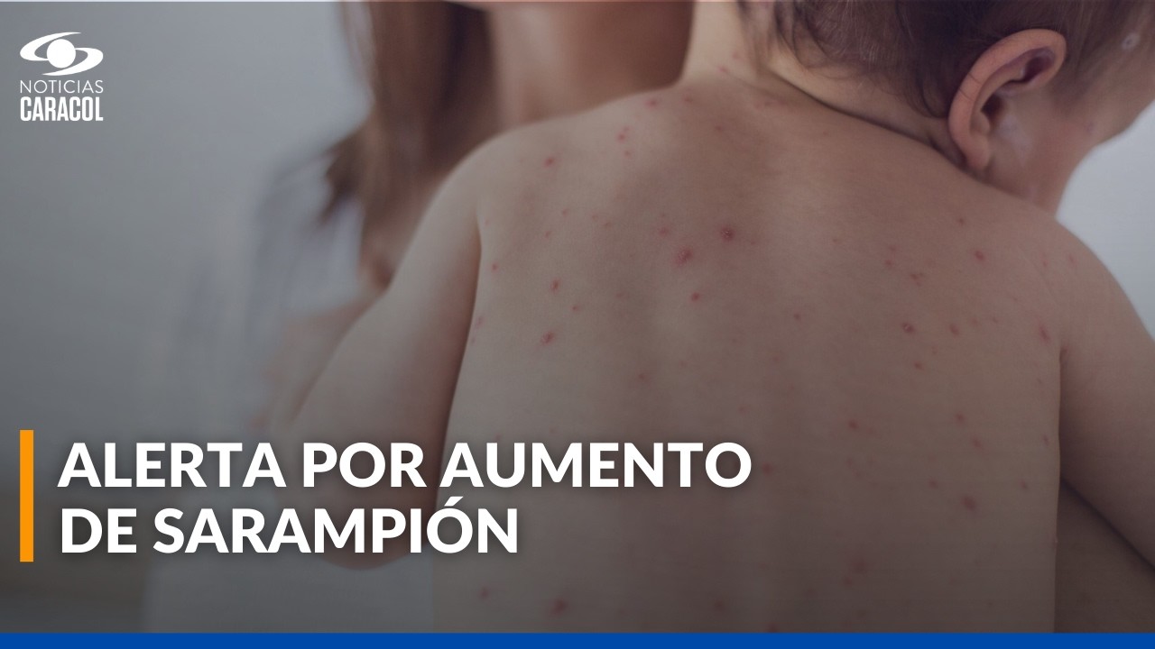 Aumentan casos de sarampión en el mundo y alertan por esquema de vacunación incompleto
