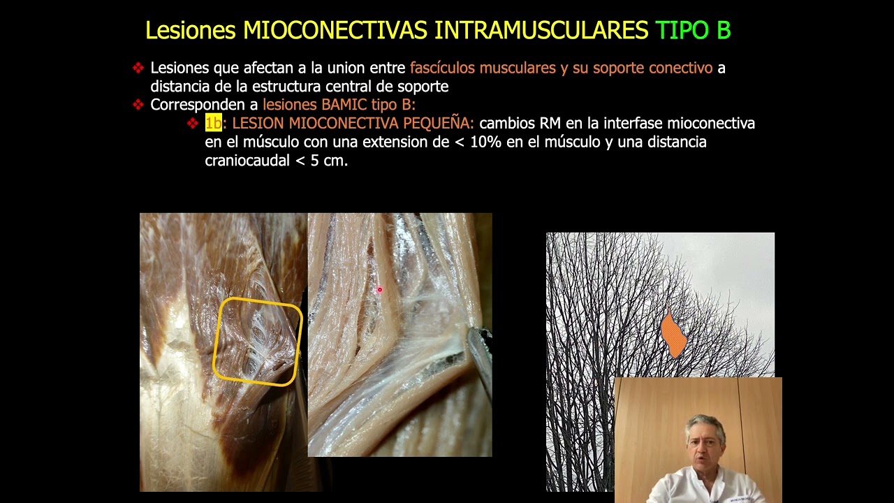 2022 03 sonoanatomía de la lesion muscular D7