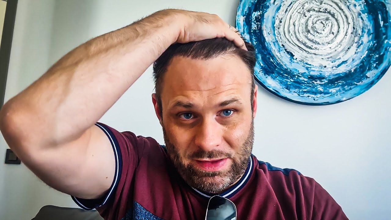 My Hair Transplant Journey 2.0 with Elithair Istanbul.