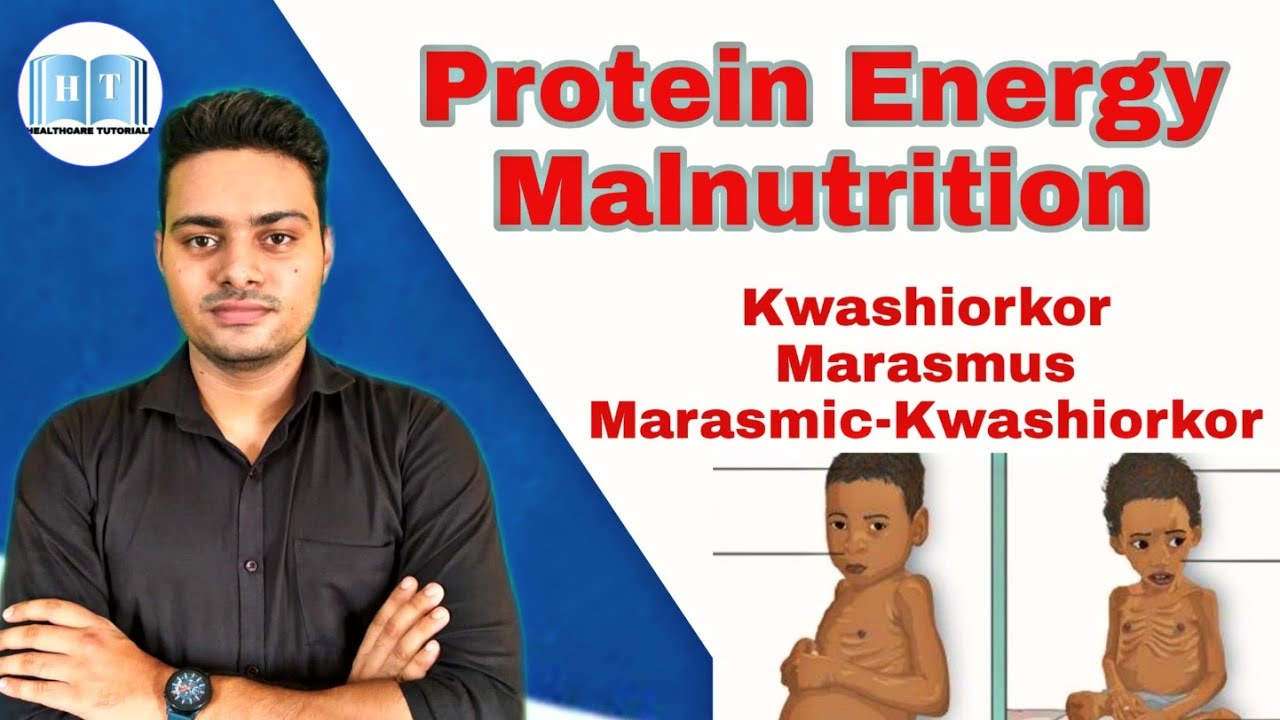 Protein Energy Malnutrition ! Kwashiorkor Vs Marasmus !