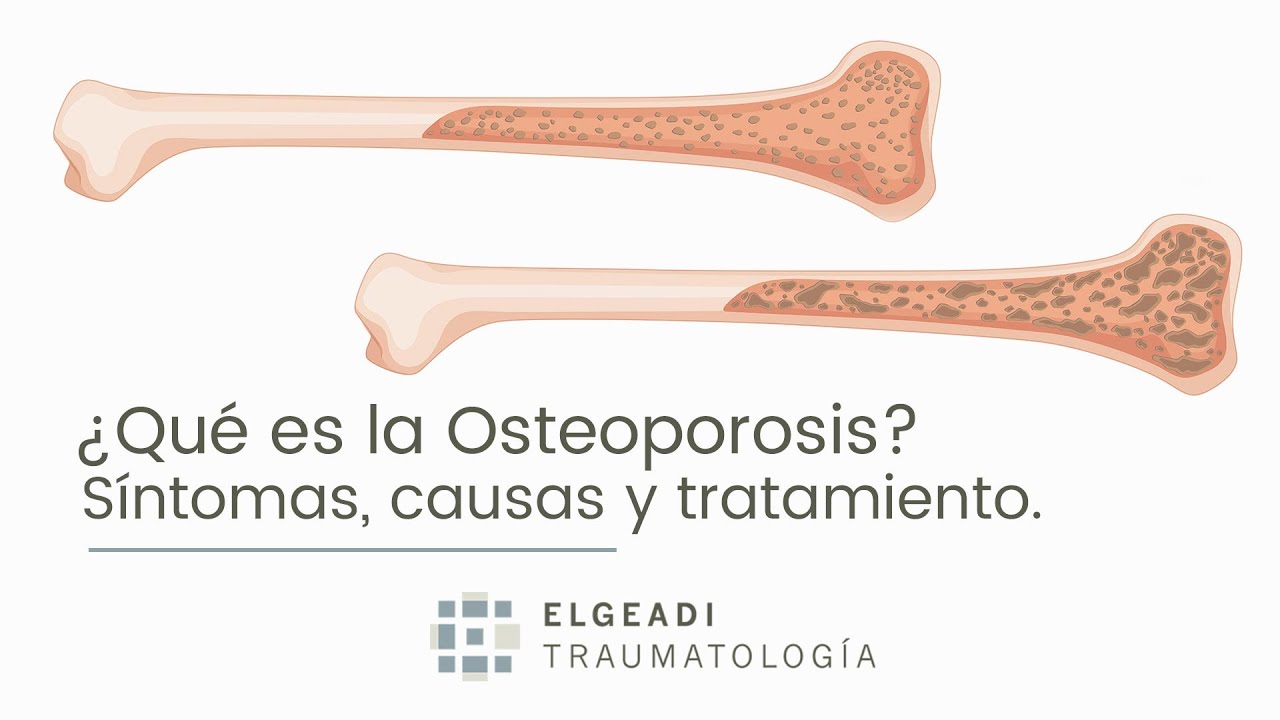 Qué es la osteoporosis: síntomas, causas y tratamiento