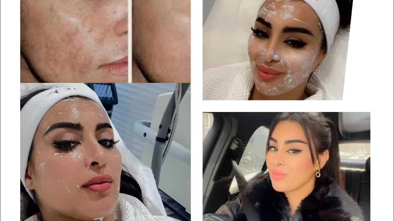 نوضي من الفخ و تهلاي فراسك عندك غير راسك اختي☺️مشينا نحرقو الجلد لبشرة صافية من بعد عمر الثلاثين 😱