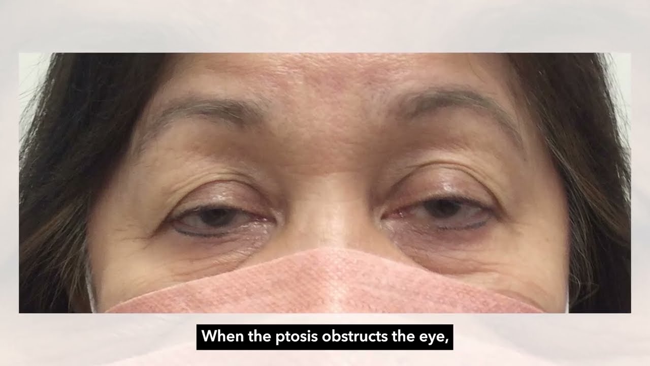 Ptosis or Drooping Eyelid - Dr. Ali Bengzon