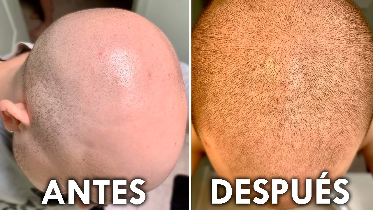 ¿El Secreto Para Recuperar Tu Pelo En 2 Meses?