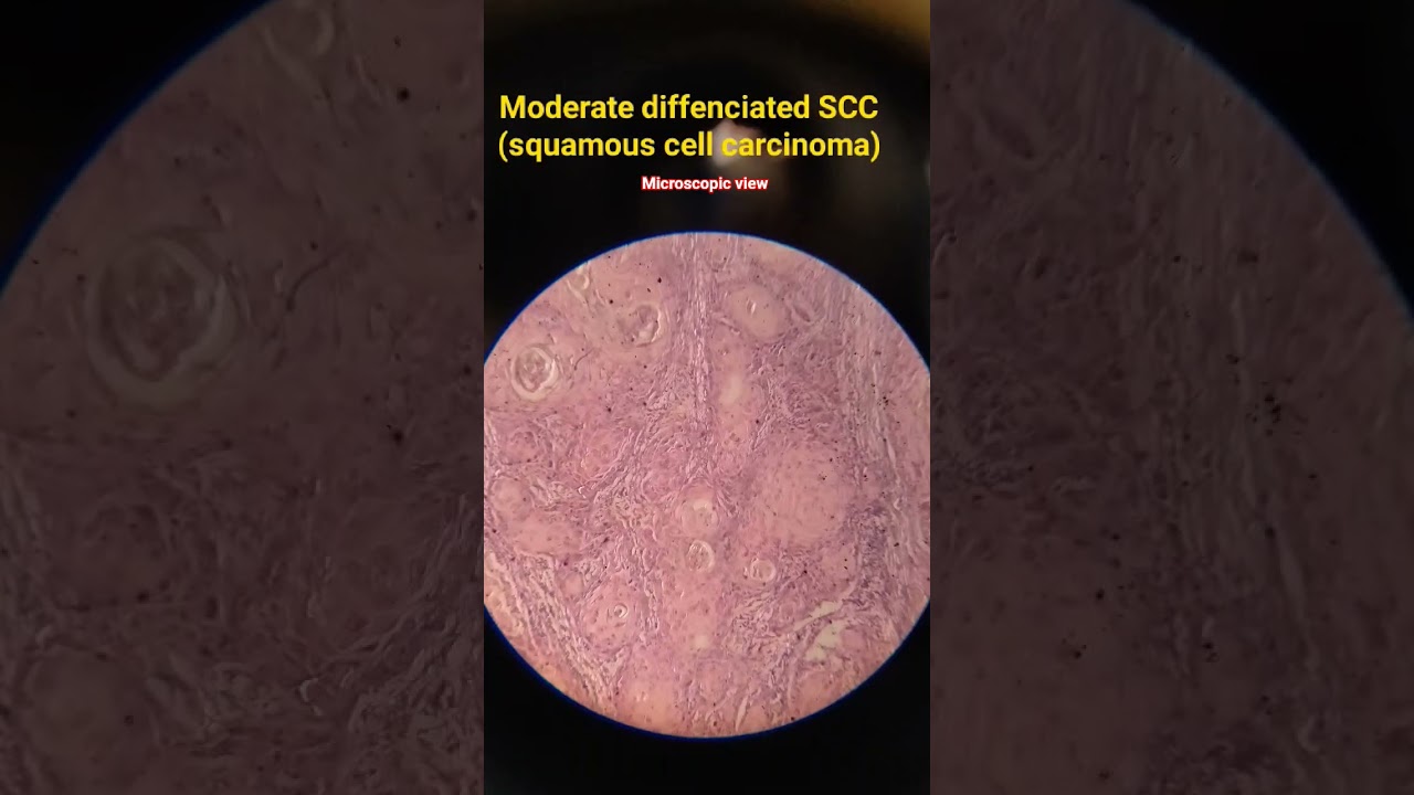 “Squamous Cell Carcinoma Under the Microscope” 