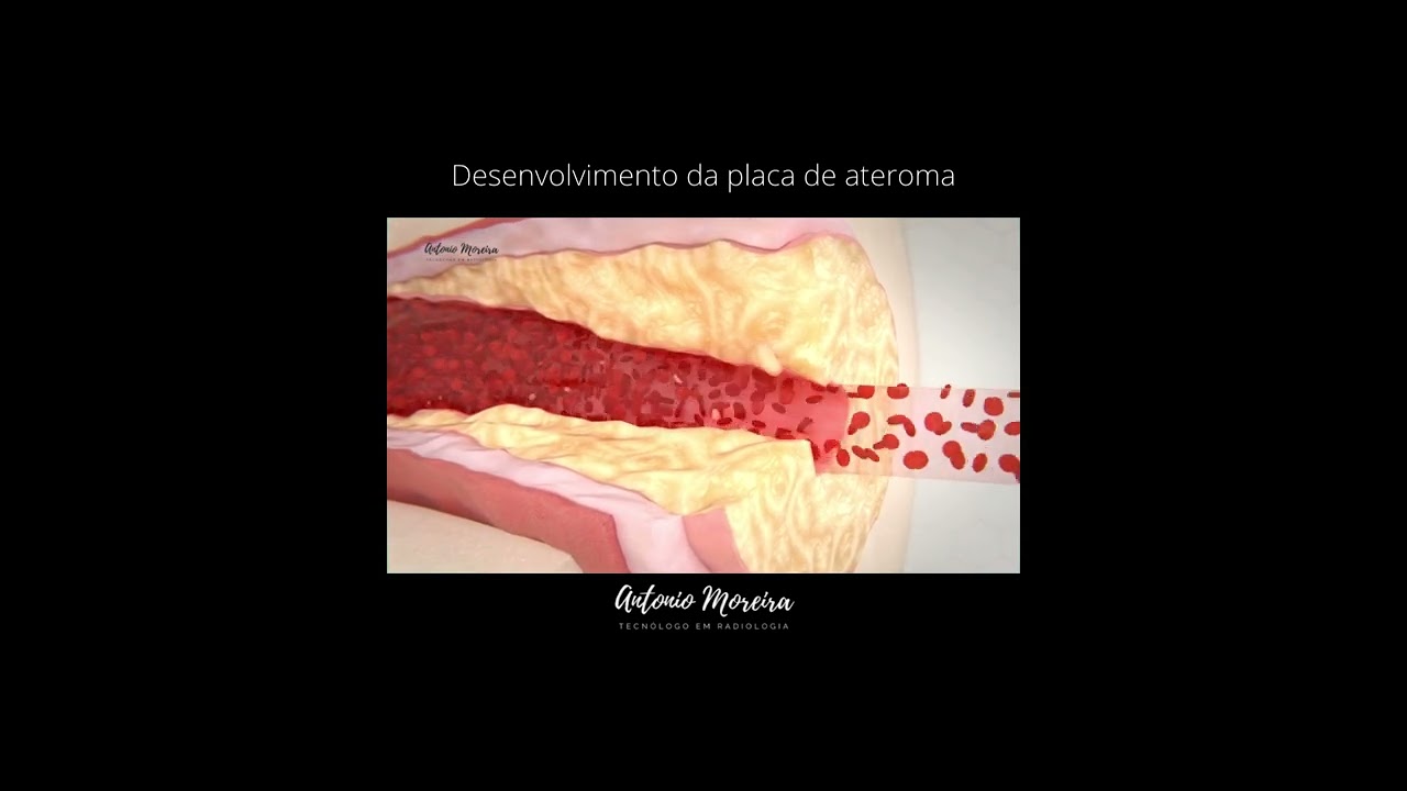Desenvolvimento de placa de ateroma (Placa de Gordura na Art&eacute;ria)