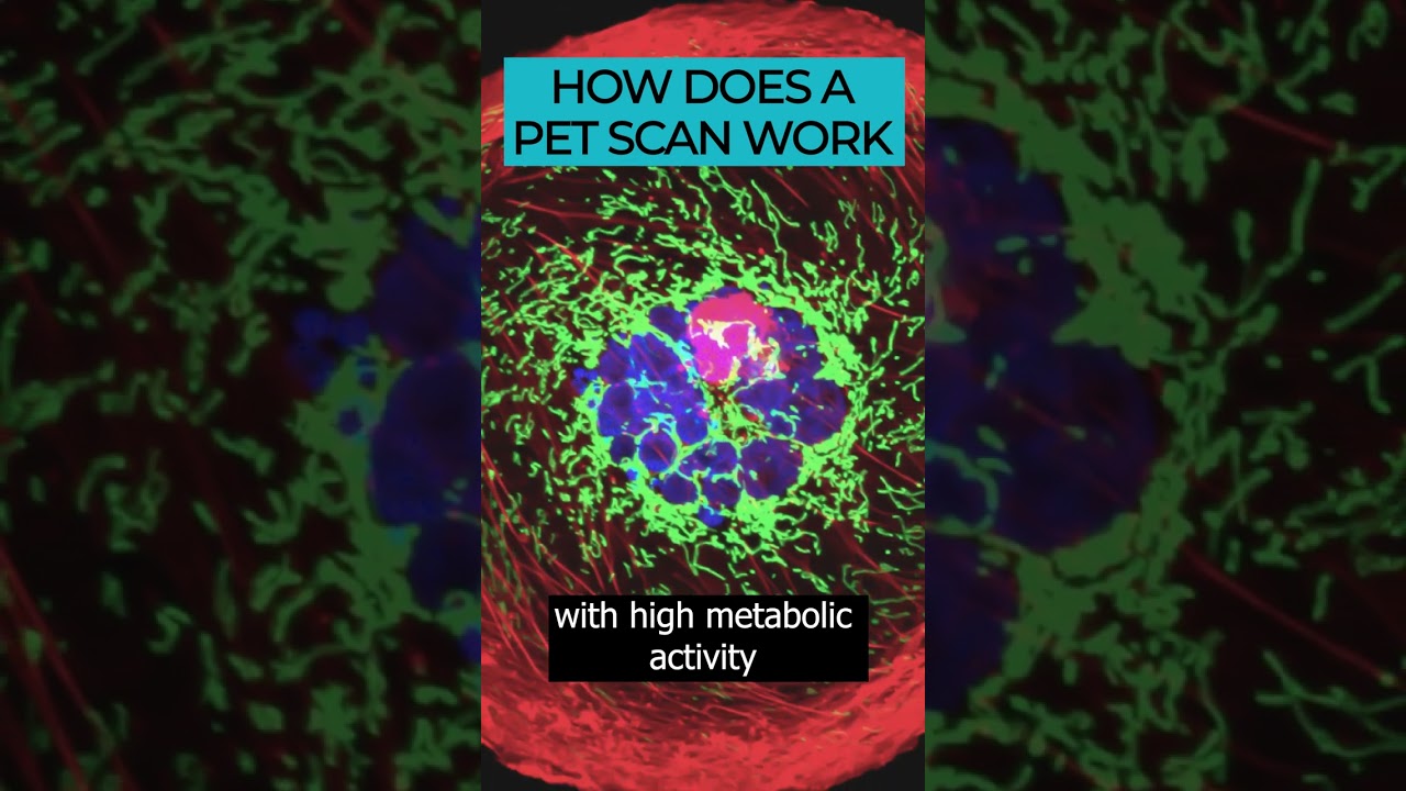 PET Scans: An advanced imaging tool for detecting cancer 🎗️🔍