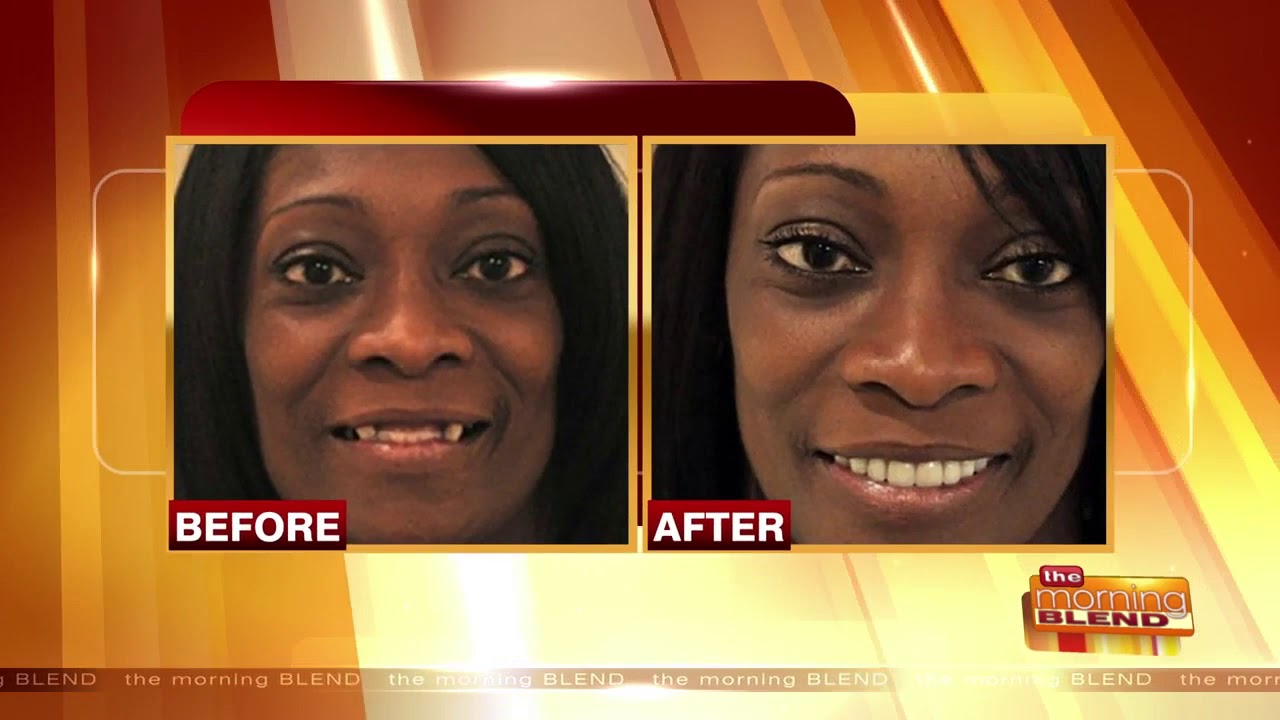 EON Clinics Dr. Amy Camba Discusses Dental Implants on The Morning Blend