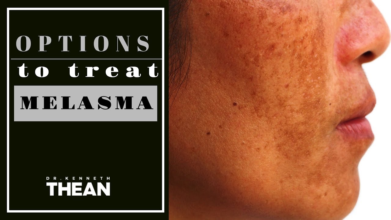 What is Melasma and how to remove it? | Dr Kenneth Thean