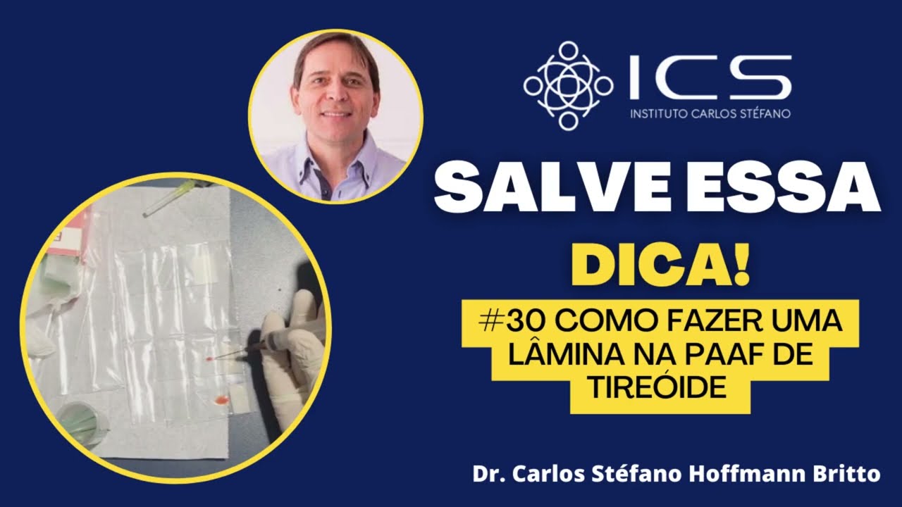 Como fazer uma l&acirc;mina na PAAF de tireoide
