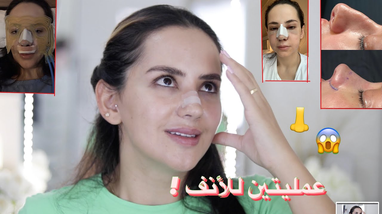 ساويت عملية أنفي👃للمرة الثانية😳الأسباب ليش عملية اولى وتانية ونصائح جدا مهمة لتتفادوا اللي مريت فيه🥺