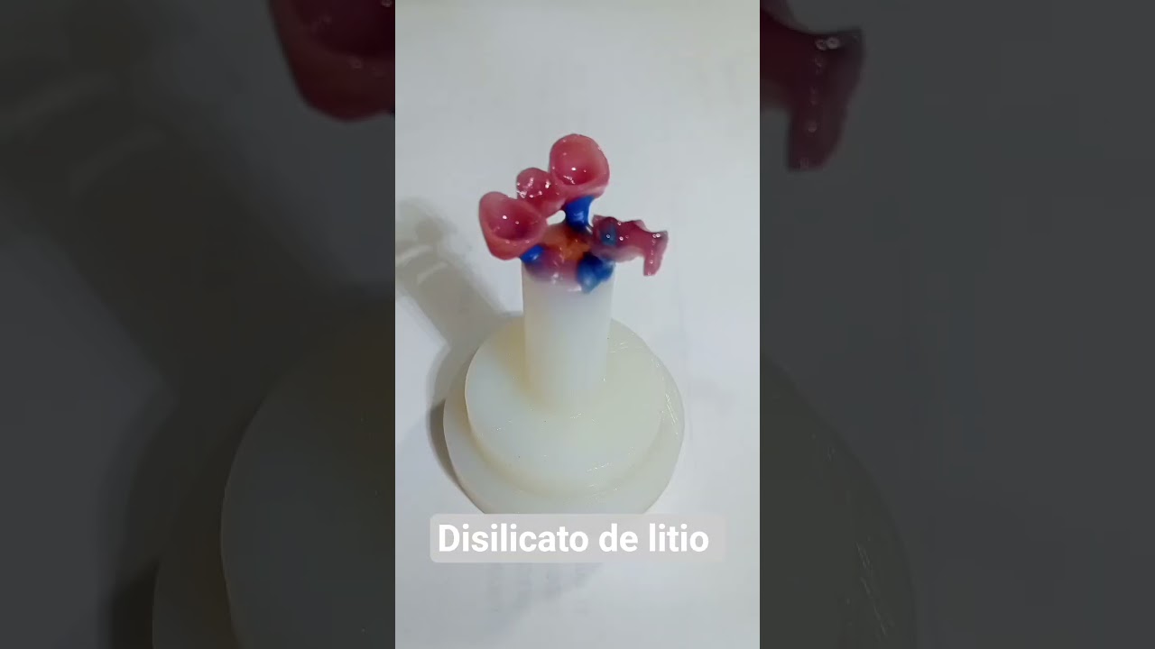 Pr&oacute;tesis fija en disilicato de litio
