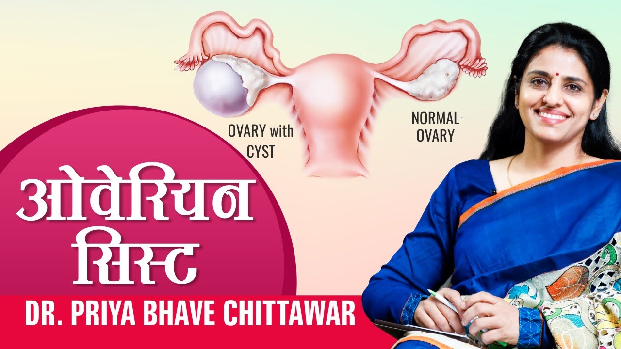 ओवेरियन सिस्ट के बारे में डॉक्टर प्रिया भावे से जानिए