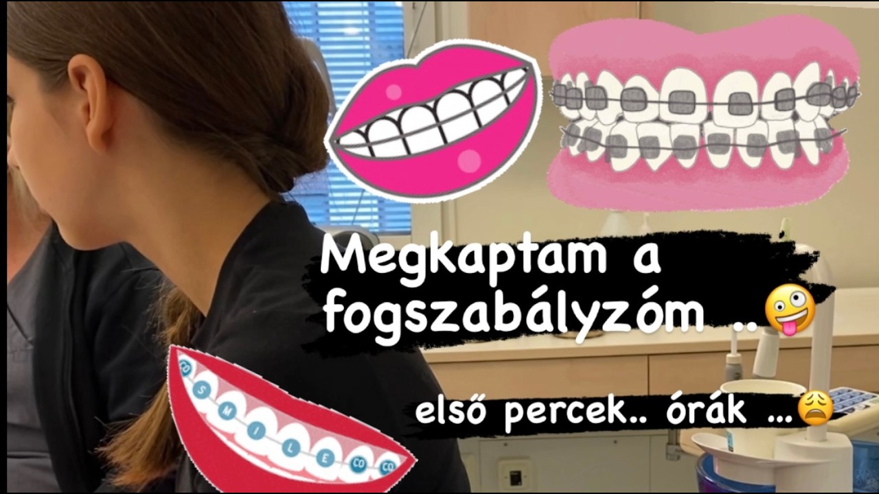 AZ ELSÖ  24  ÓRA !😱 MEGKAPTAM! MILYEN SZÍNÜ LETT A GUMIJA? - SVÉDORSZÁGI ÉLETÜNK #fogszabályzo