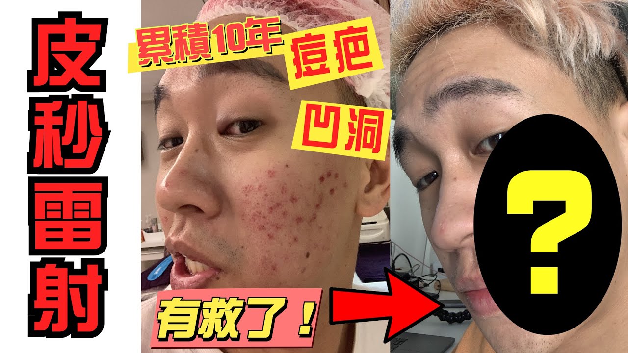 困擾10多年的痘疤凹洞終於有救了，皮秒雷射修復全紀錄