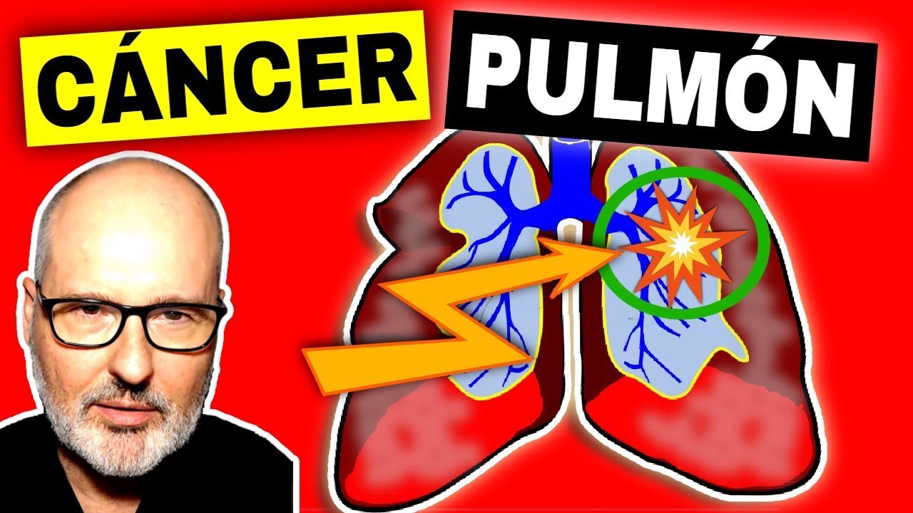CÁNCER de PULMÓN : Síntomas, Causas, Tratamiento (y Prevención)