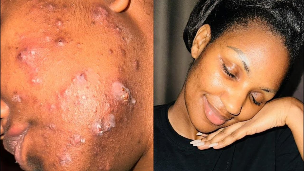 HOW I CLEARED MY SKIN WITH ONE PRODUCT / UKO NAKIZE IBIHERI #acne #roacutane #rwanda #skincare