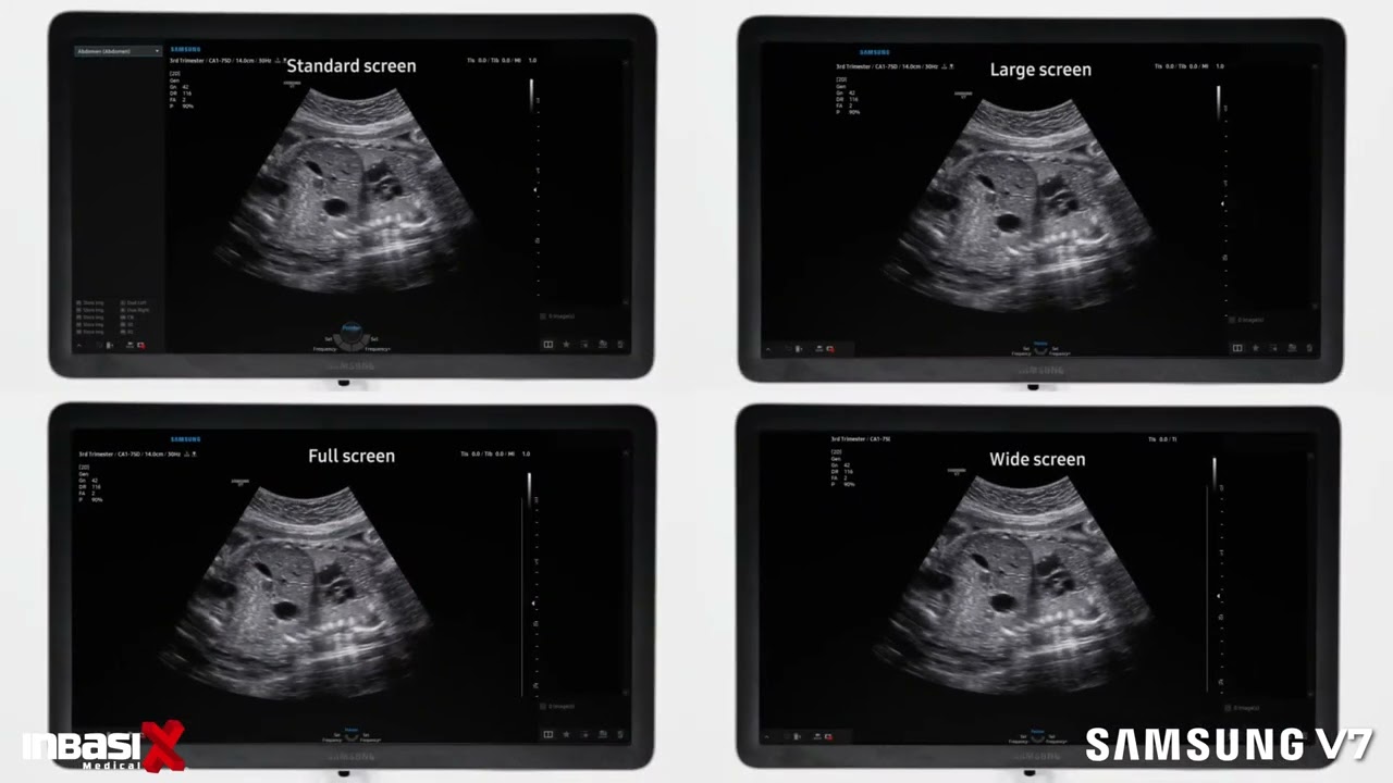 Ultrasonido Samsung V7 para la salud de la mujer
