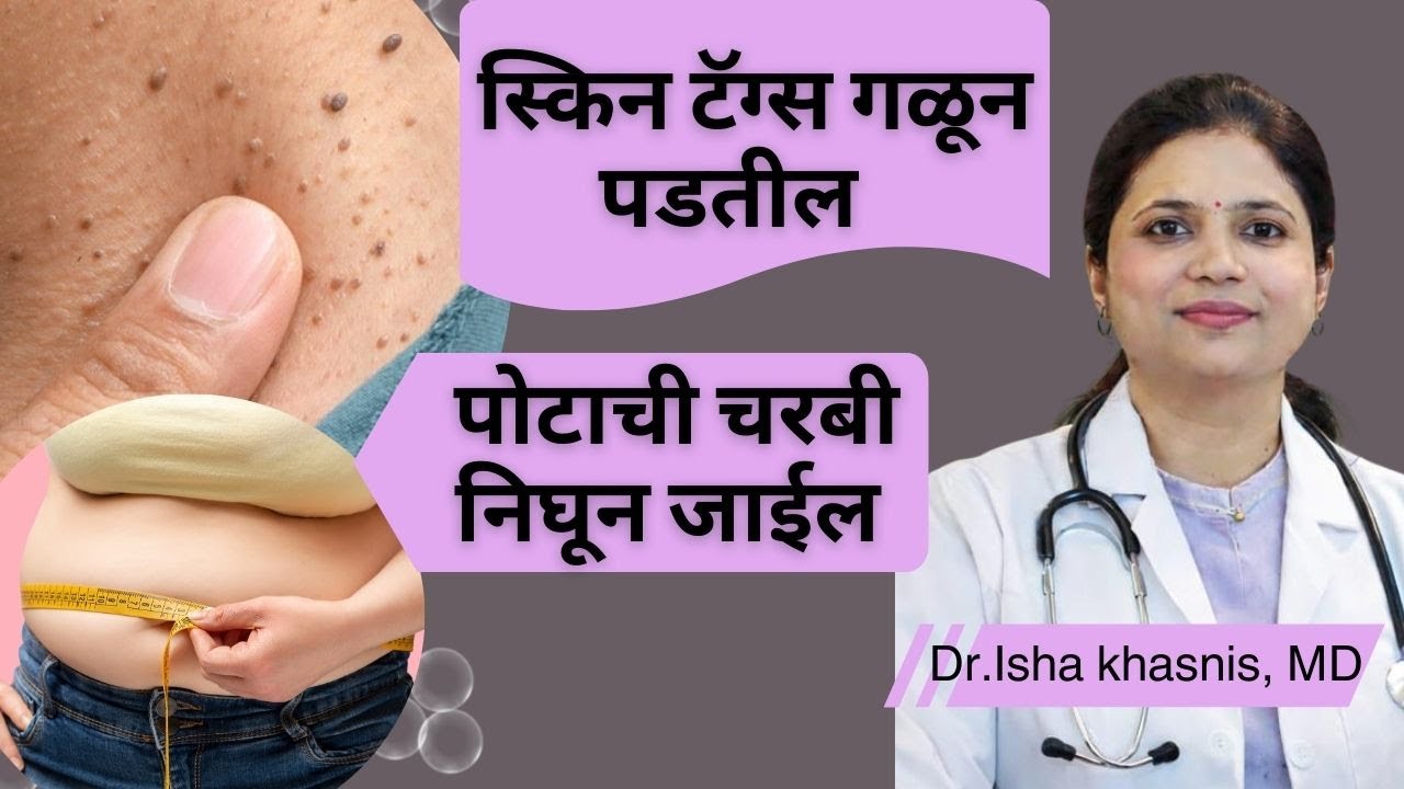 स्किन टॅग्स गळून पडतील , पोटाची चरबी निघून जाईल |by Dr. Isha