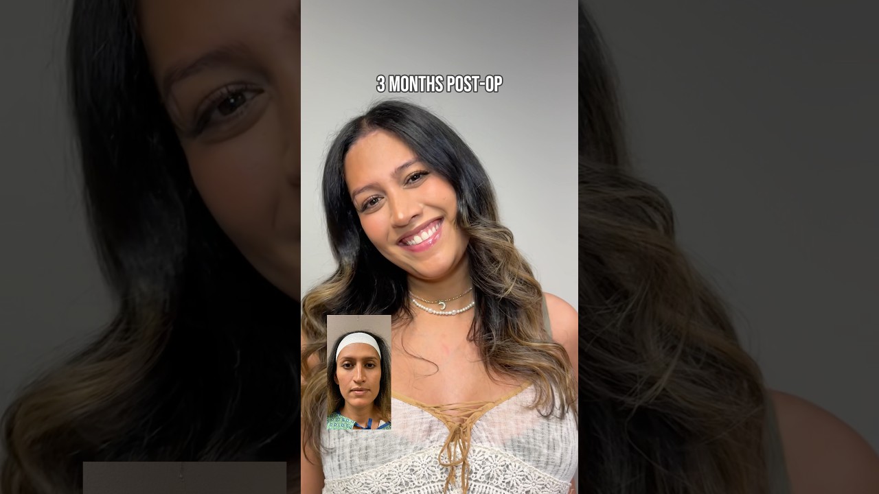 FFS | Facial Feminization Surgery Transformation