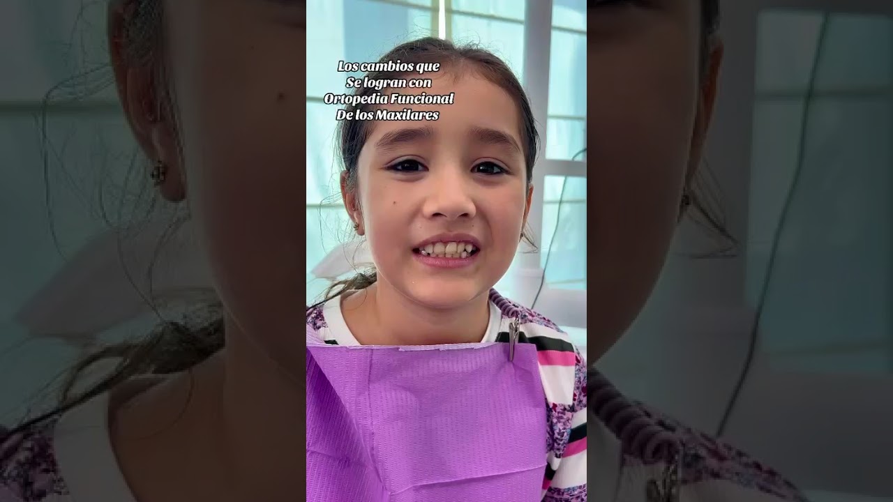 🔹 Antes y Después | Ortopedia Funcional de los Maxilares en niños – Caso real