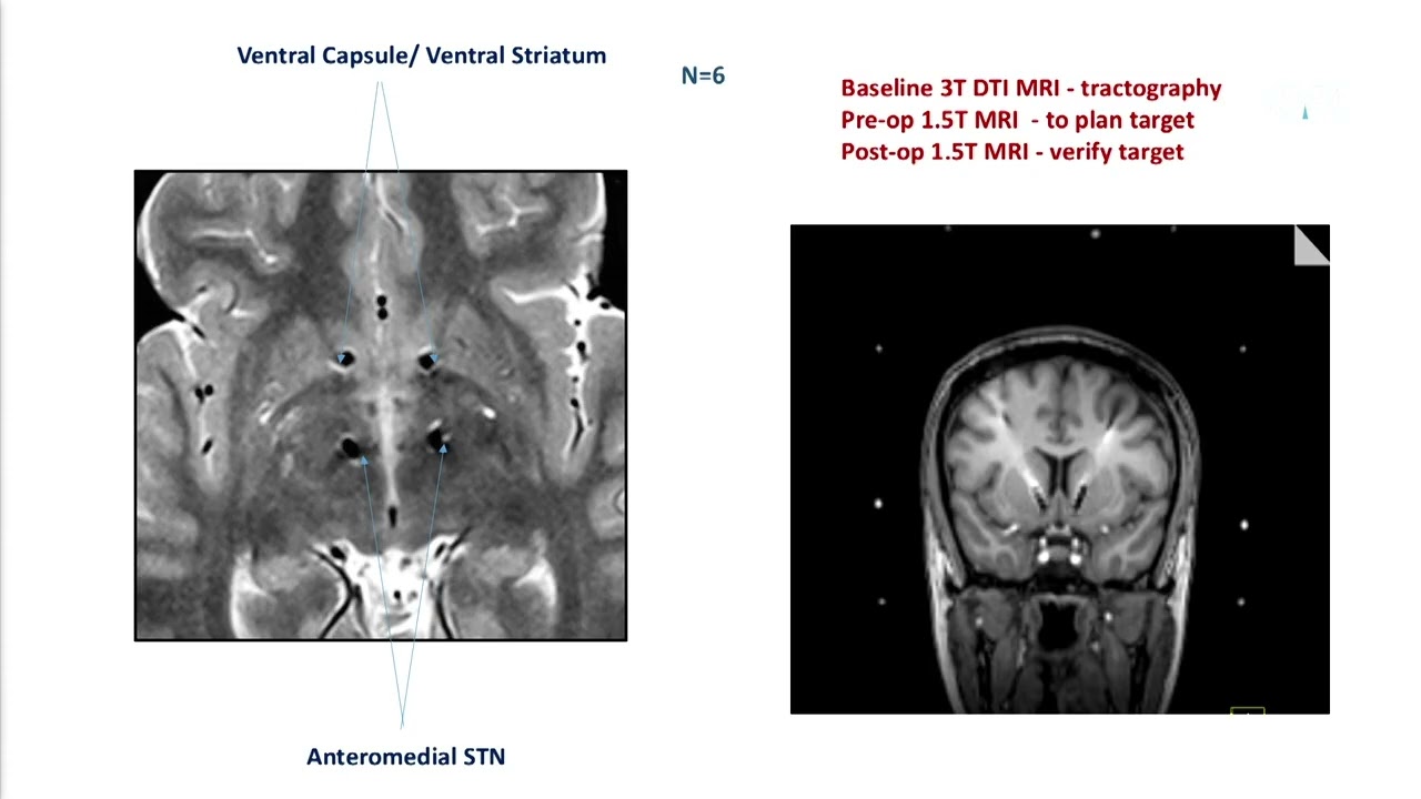 Deep Brain Stimulation for OCD - Eileen Joyce