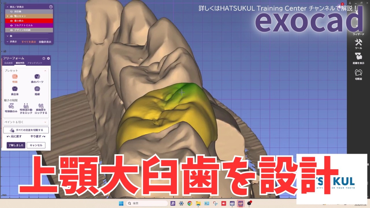 #320　exocad設計　上顎大臼歯を設計！（解説なし版）