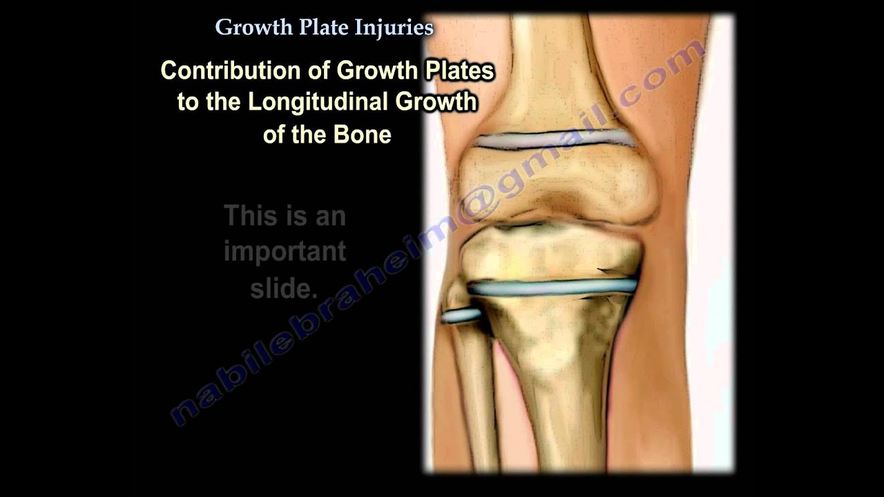 Growth Plate Injuries ,Overview- Everything You Need To Know - Dr. Nabil Ebraheim