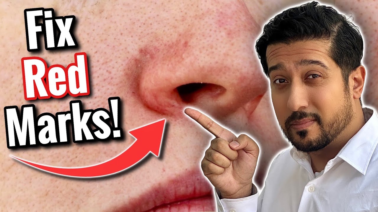 Redness Around Nose | Get Rid of Perioral Dermatitis FAST