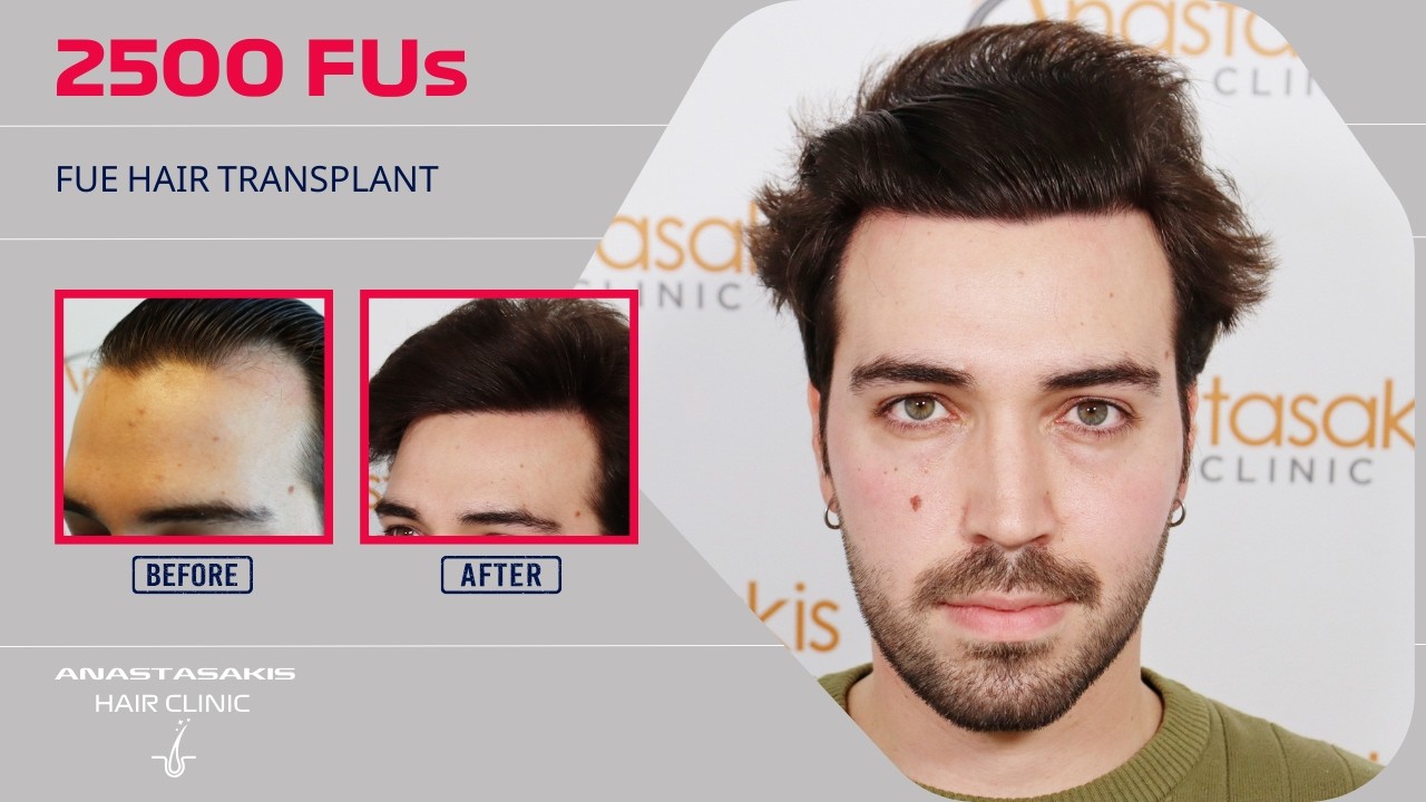 ✂️ Η Λεπτομέρεια που Κάνει τη Διαφορά: Νέο Hairline σε 12 Μήνες | case #428